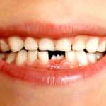 早くしてー！【朗報】虫歯で歯を削らずに、