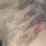 【警告】エステ脱毛に･･･「皮膚がずるむけの状態」被害1000件超！