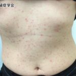 なぜ、長野市“梅毒過去最多”！？マッチングアプリで見知らぬ人との出会いが一因か...