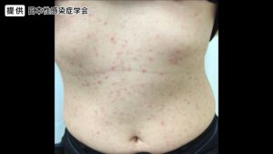 なぜ、長野市“梅毒過去最多”!?マッチングアプリで見知らぬ人との出会いが一因か...